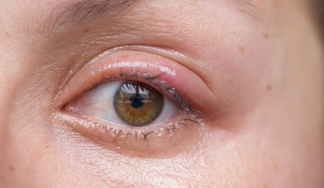 Homeopathic Remedies for Blepharitis: A Natural Approach to Eye Health