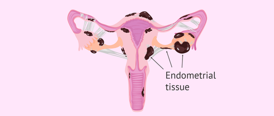 The Endometriosis Nosode